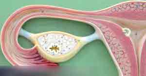 تاثیر سندروم تخمدان پلی کیستیک در سلامت زنان 