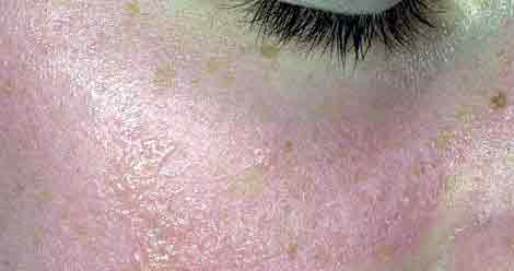 علت‌های شایع قرمزی صورت 