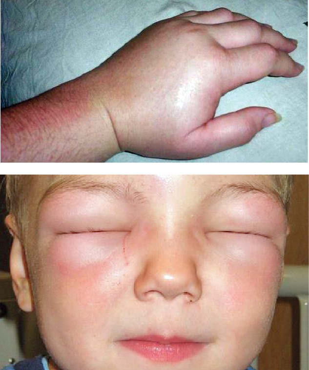 برنامه غذایی و شیوه زندگی صحیح برای مبتلایان به آنژیوادم